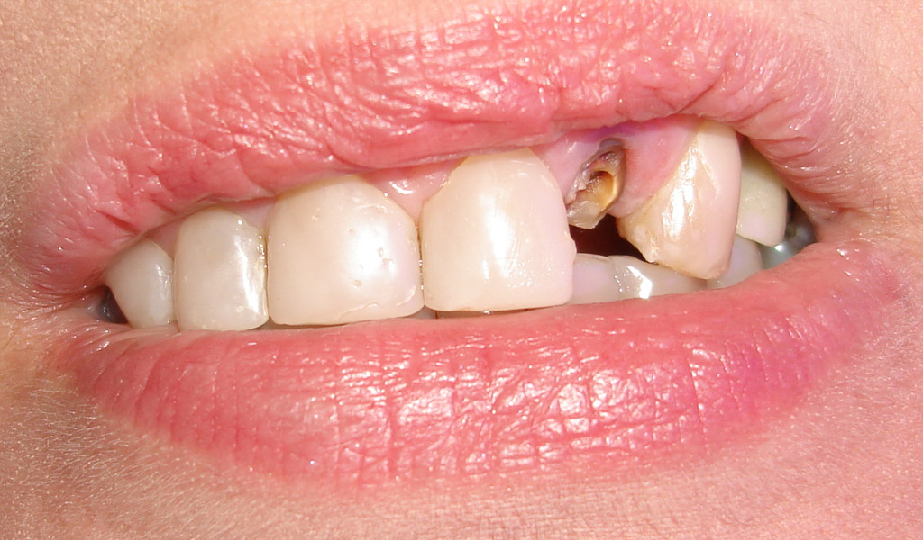 Urgencias dentales pérdida de diente
