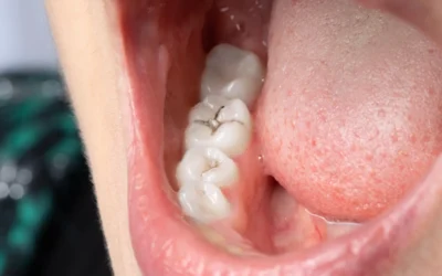 Caries en adultos: causas, síntomas y tratamiento