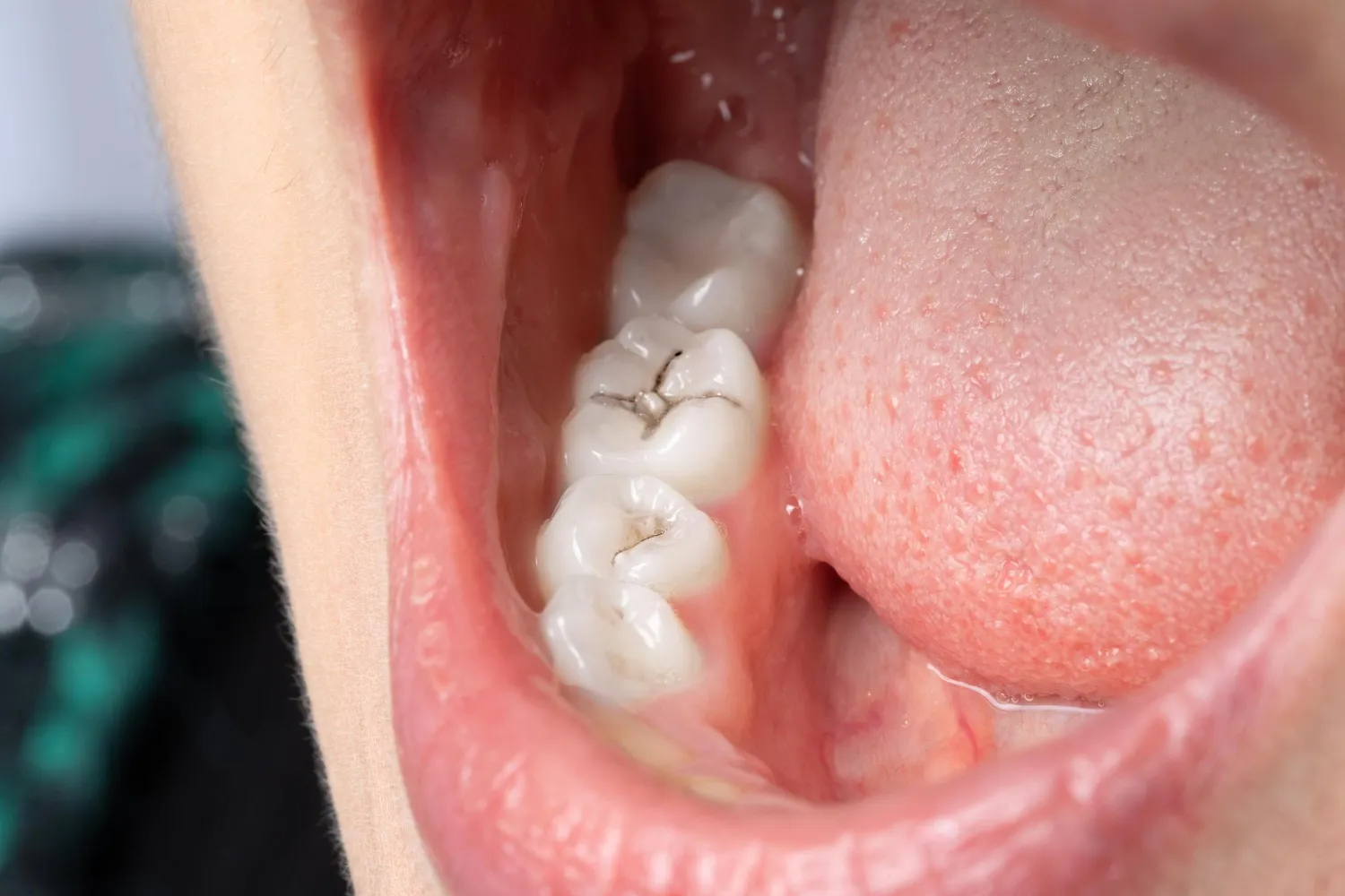 blog Caries en adultos sintomas tratamiento