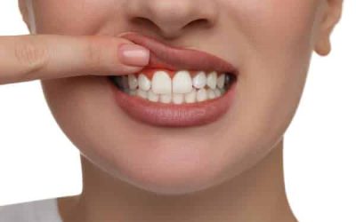 Perdida de encía: Cómo prevenir y tratar la retracción de encías
