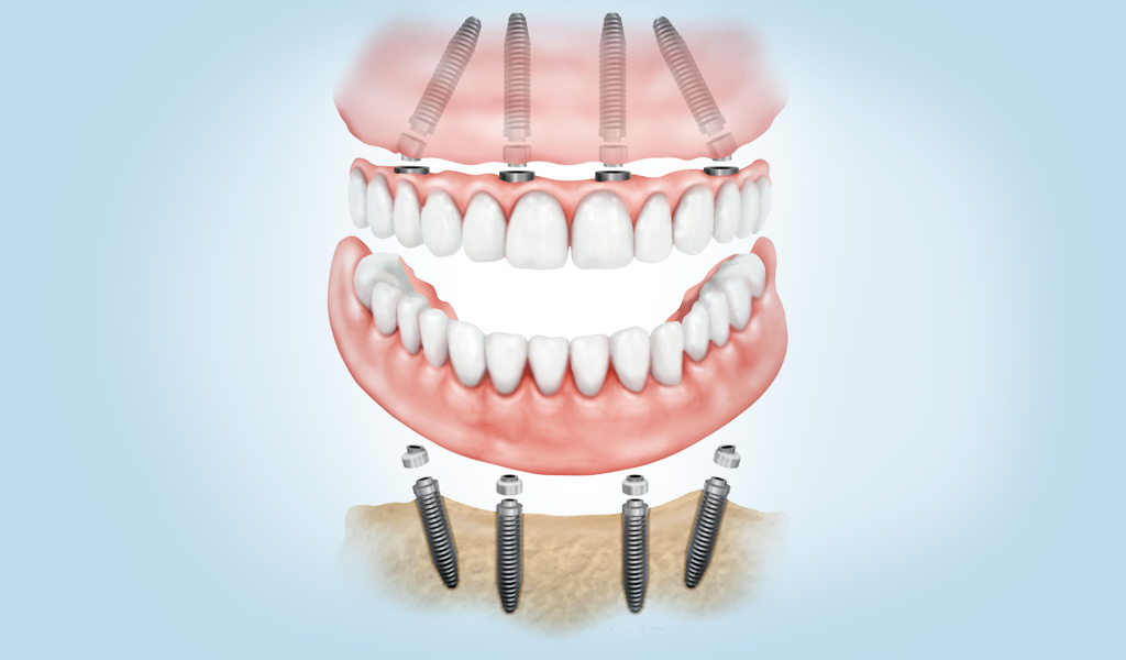 implantes dentales en Mollet del Vallès