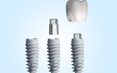 Diferentes opciones sobre implantes dentales en Mollet del Vallès