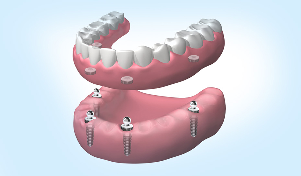 implantes dentales en Mollet del Vallès