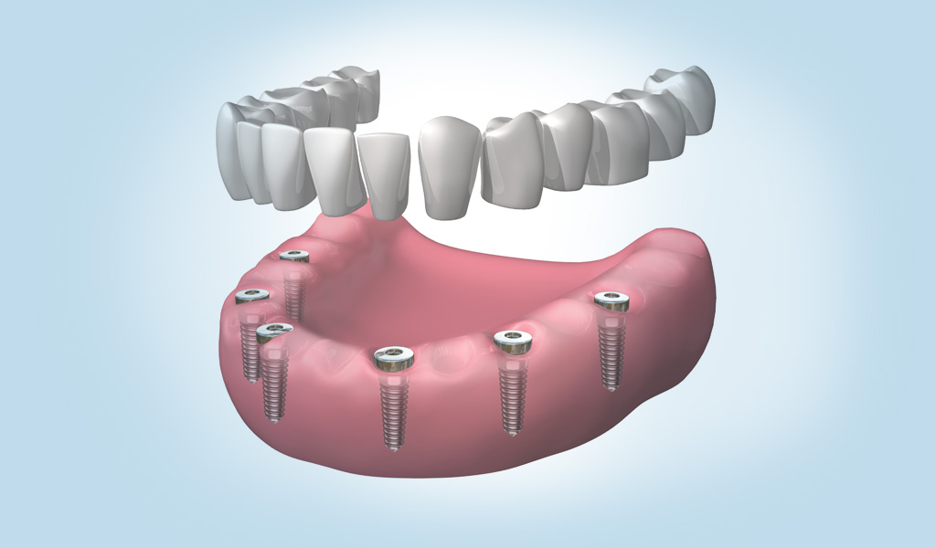 implantes dentales en Mollet del Vallès
