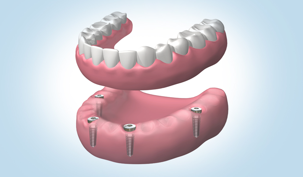 implantes dentales en Mollet del Vallès