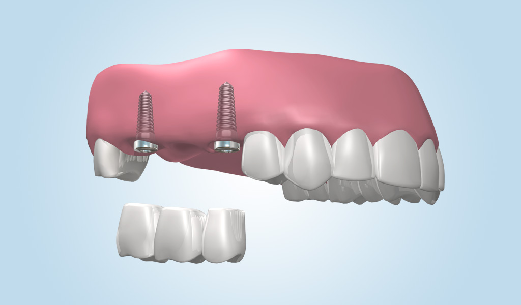 Puente dental