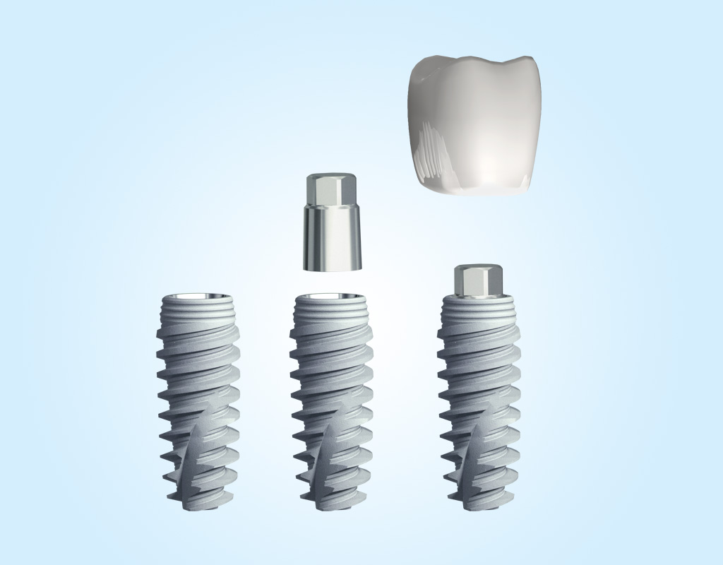 implantes dentales en Mollet del Vallès implantes dentales en Mollet del Vallès