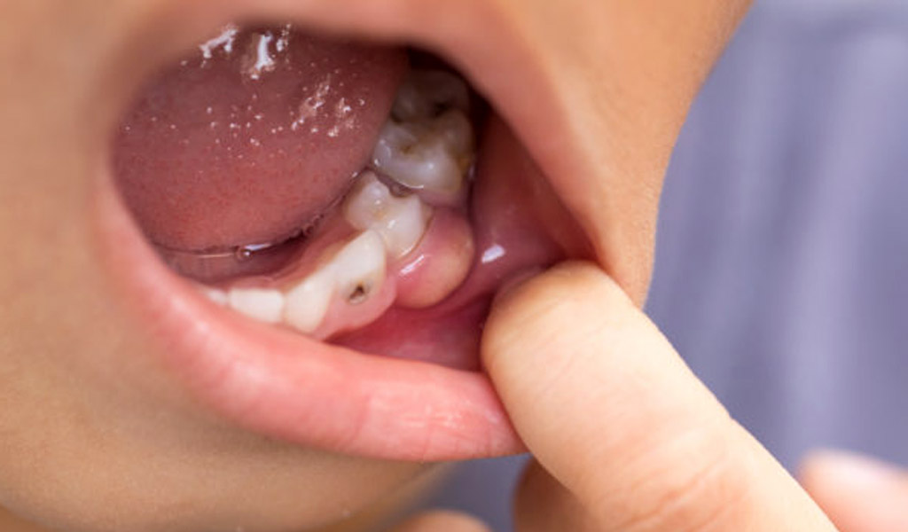 Urgencias dentales en Mollet del Vallès