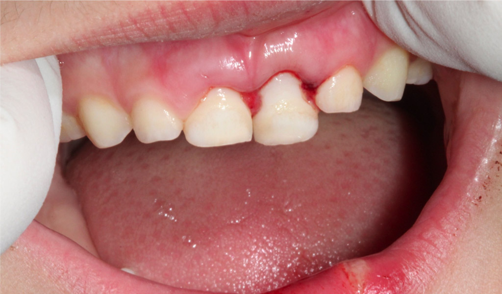 Urgencias dentales en Mollet del Vallès