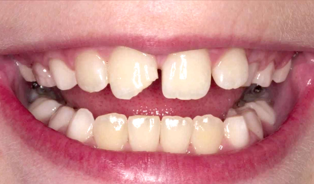 Urgencias dentales en Mollet del Vallès